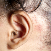 אטופיק דרמטיטיס: מחלת העור שתוקפת 20% מהילדים בעולם המערבי